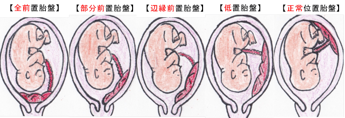 前置胎盤の種類の図解